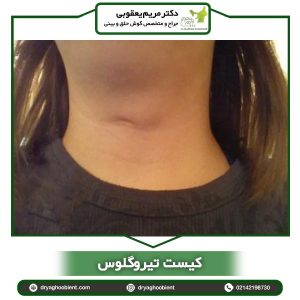 کیست تیروگلوس