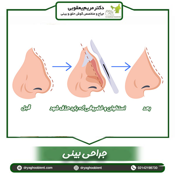 جراحی بینی - دکتر یعقوبی