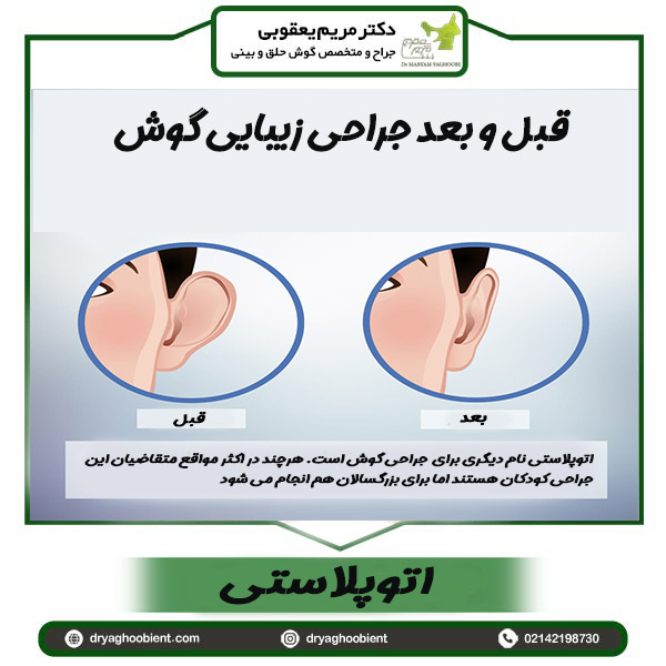 اتوپلاستی _ دکتر مریم یعقوبی