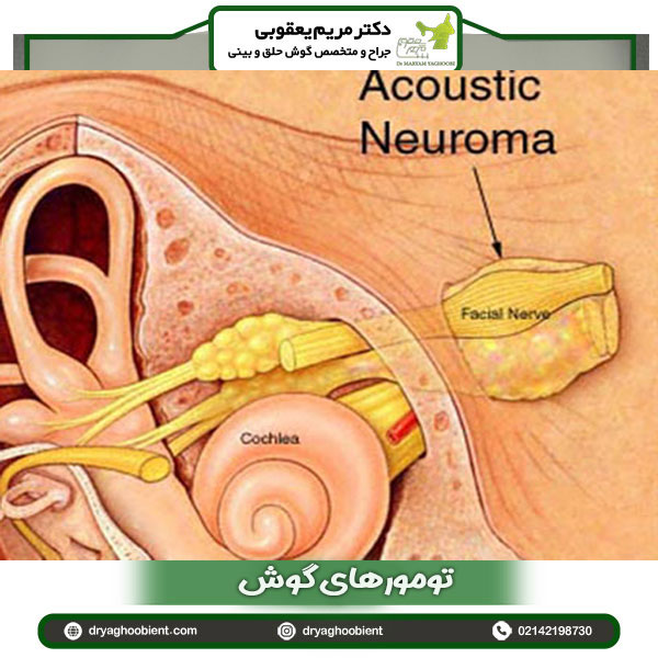 تومورهای گوش