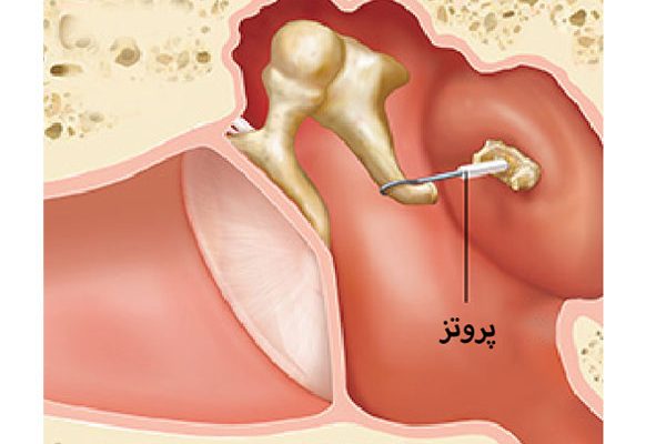 عمل استاپدکتومی