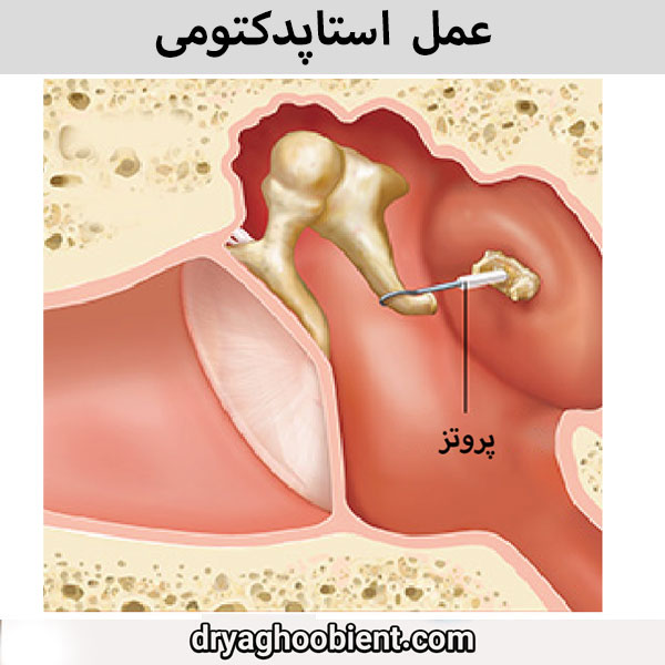 عمل استاپدکتومی