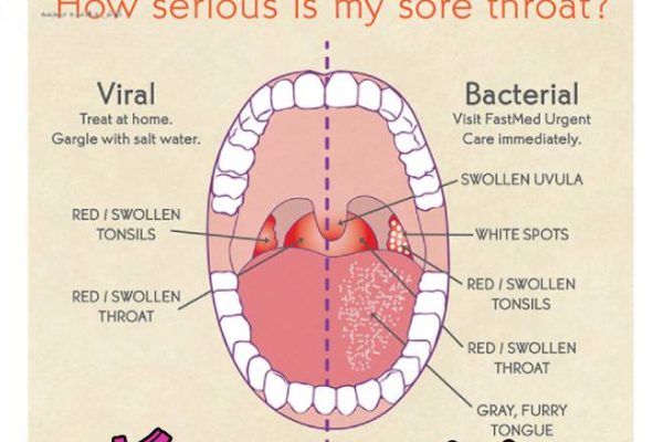 عفونت ویروسی گلو - دکتر مریم یعقوبی
