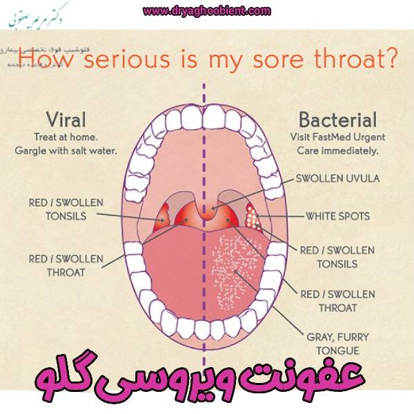 عکس عفونت ویروسی گلو - دکتر مریم یعقوبی